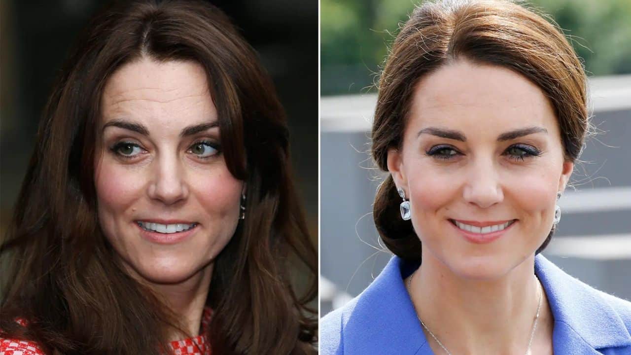 Kate Middleton Plastic Surgery: Before And After Photos